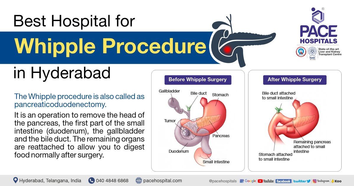 whipple procedure for pancreatitis