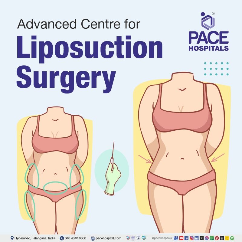 liposuction surgery cost in Hyderabad | best liposuction surgery in Hyderabad | best liposuction treatment in Hyderabad | laser liposuction Hyderabad cost | Liposuction Procedure near me