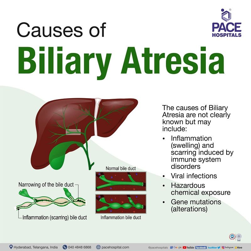 biliary atresia causes