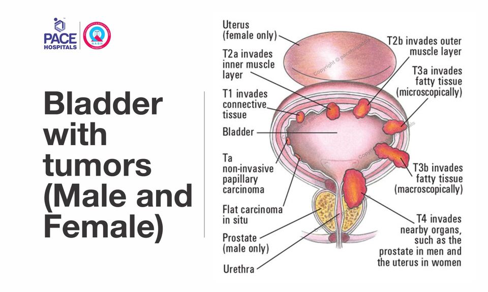 Bladder with tumors (Male and Female)