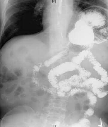 A beautiful case: Left sided Bochdalek Hernia