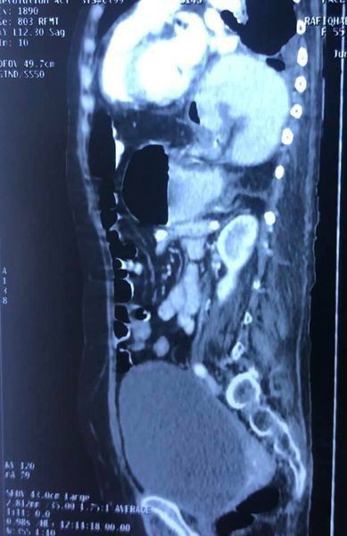 Image of Bochdalek Hernia