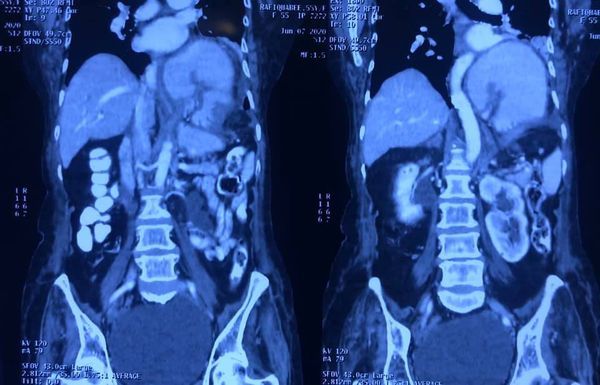 Image of Bochdalek Hernia