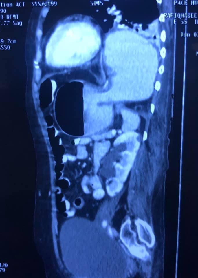 Image of Bochdalek Hernia