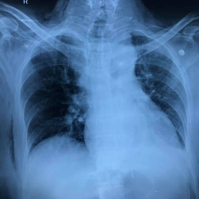 Image of Bochdalek Hernia