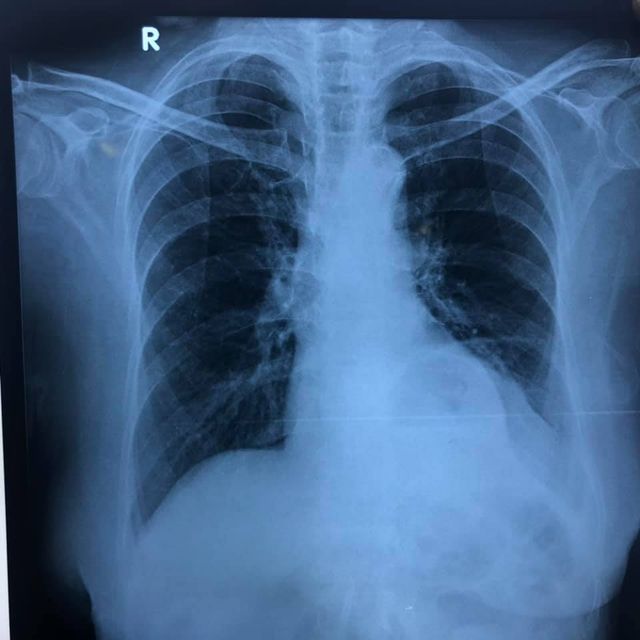 Image of Bochdalek Hernia