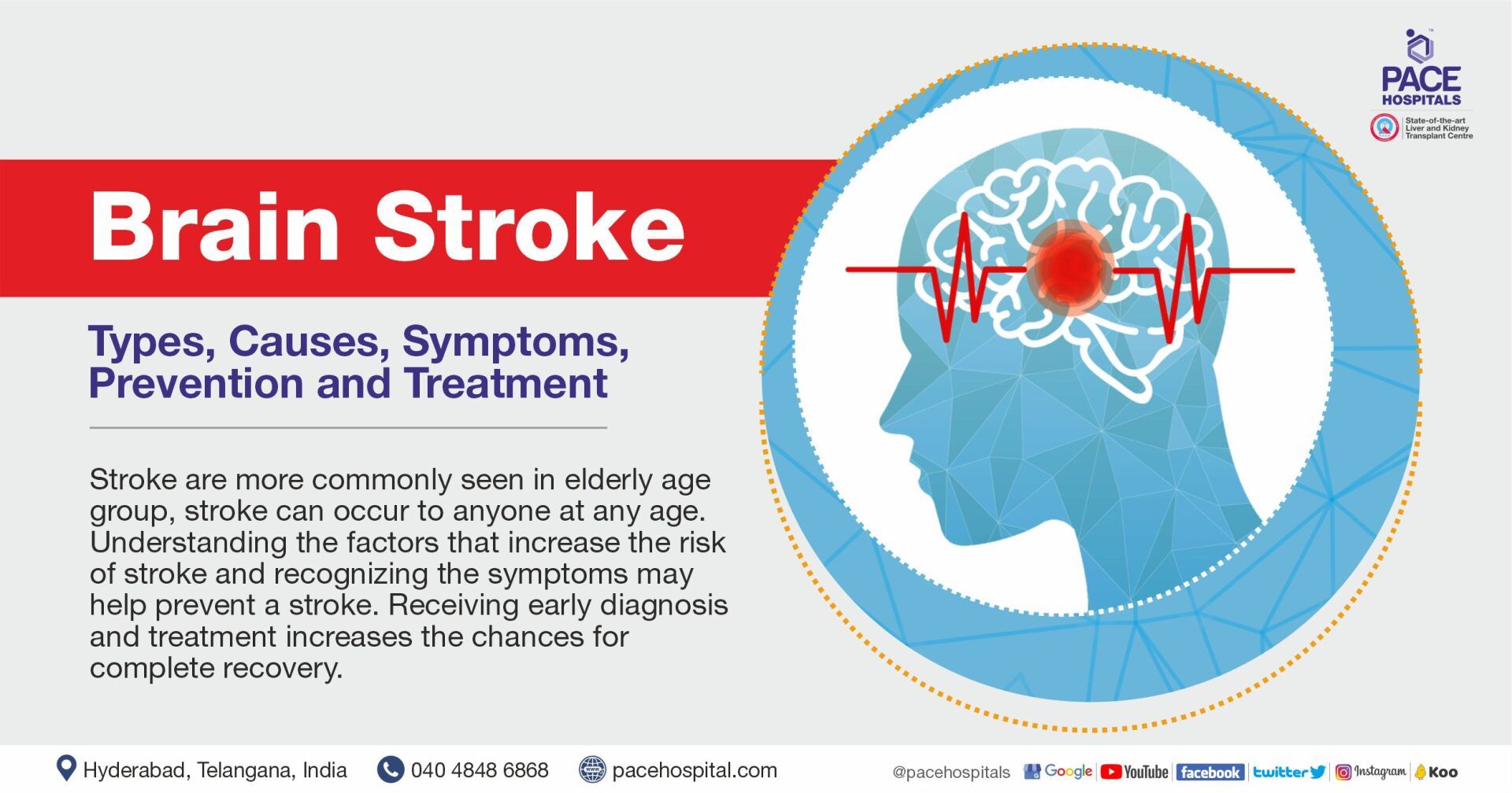 different types of strokes