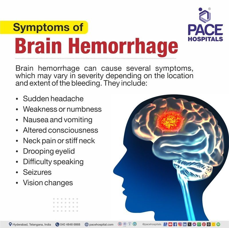 brain hemorrhage symptoms​ | symptoms of brain hemorrhage​ | slow brain hemorrhage symptoms​ | what are the symptoms of brain hemorrhage​