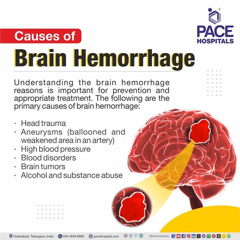 what causes a brain hemorrhage​ | brain hemorrhage causes​ | what is the cause of brain hemorrhage​ | what is the cause of brain hemorrhage​
