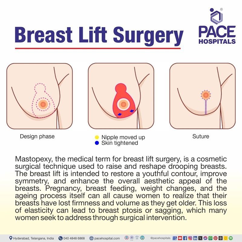 breast lift surgery​ | breast lift surgery near me​ | mastopexy | what is breast lift surgery​ | breast lift mastopexy surgery​