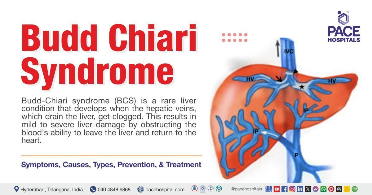 Budd Chiari syndrome | what is Budd Chiari syndrome | how to treat Budd Chiari syndrome