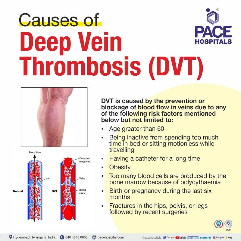 dvt causes | deep vein thrombosis causes | dvt disease causes | causes of dvt | causes of deep vein thrombosis in leg
