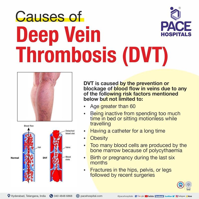 Deep Vein Thrombosis, DVT - Symptoms, Causes and Complications