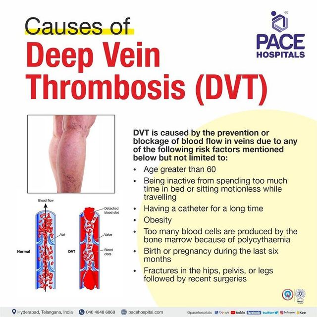 Deep Vein Thrombosis DVT Symptoms Causes And 41 OFF