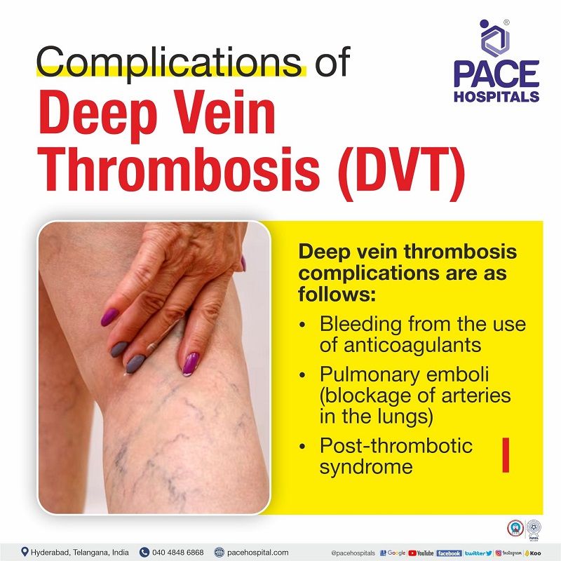 Deep Vein Thrombosis Dvt Symptoms Causes And Complications