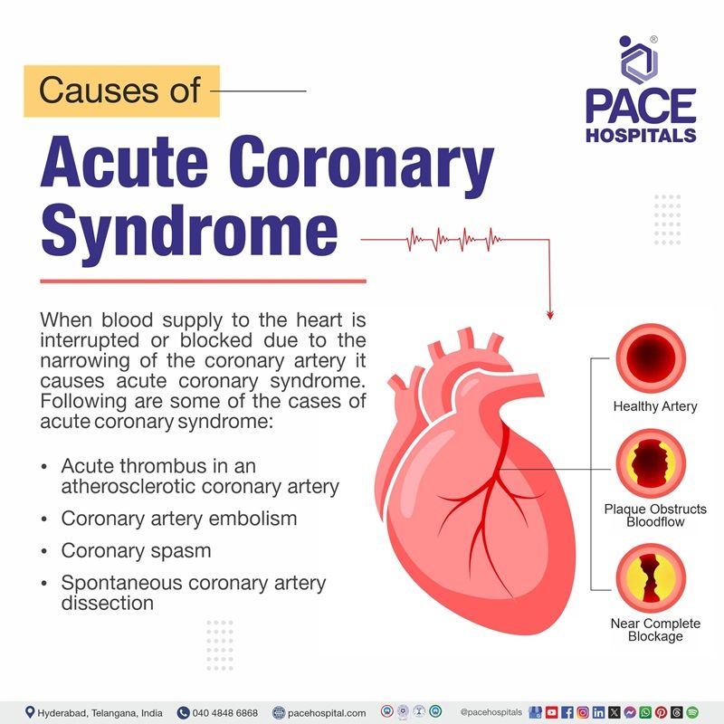 Acute coronary syndrome causes acute coronary syndrome causes | most common cause of acute coronary syndrome | Causes of acute coronary syndrome | What are the causes of acute coronary syndrome