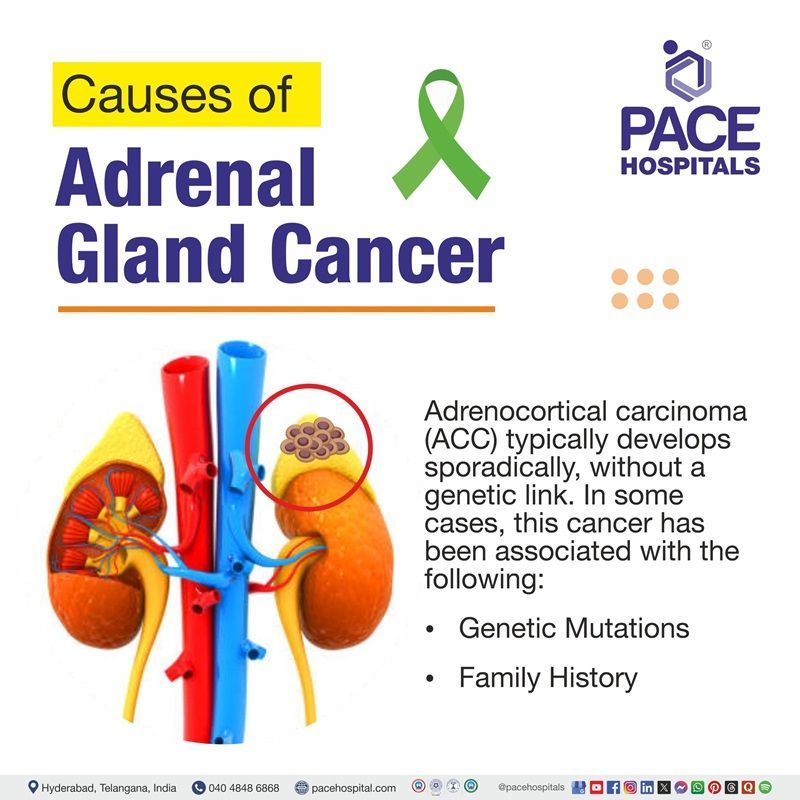 Adrenocortical carcinoma causes​ | illustration showing the cancer affected kidneys and the causes of adrenal gland cancer
