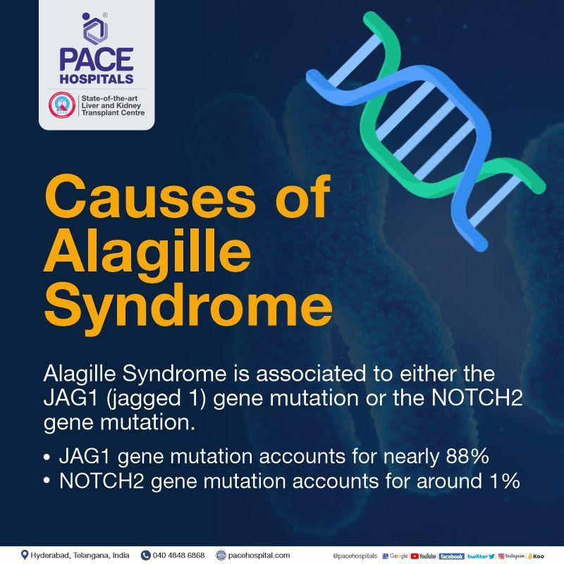 Alagille syndrome Causes