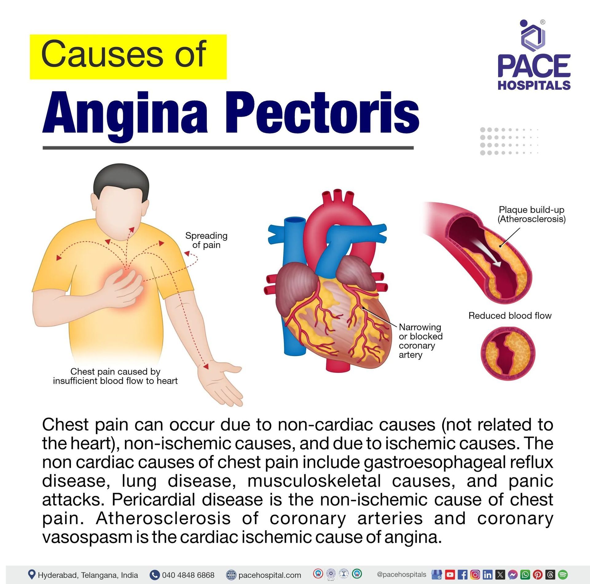 angina pectoris causes​ | what is angina pectoris and what causes it​
 | angina pectoris is caused by​ | what causes angina pectoris​