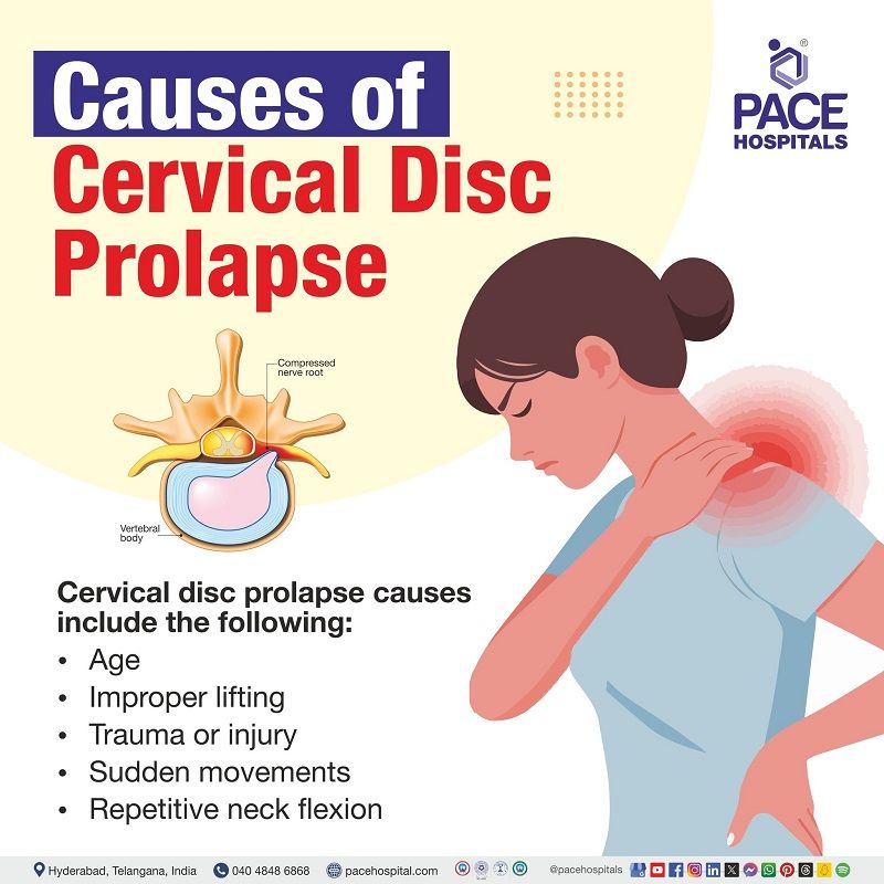 cervical disc prolapse causes | Causes of Cervical Disc Prolapse | what causes  Cervical Disc Prolapse | Visual outlining the causes of Cervical Disc Prolapse | What are the causes of  Cervical Disc Prolapse