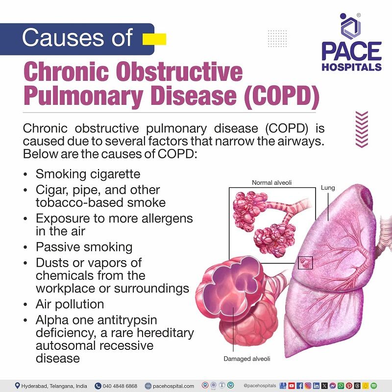 COPD causes | causes of COPD disease | what causes COPD | COPD causes and risk factors | COPD is caused by | Visual depicting the causes of COPD
