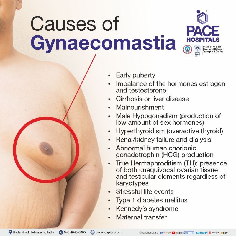 gynecomastia causes | gynaecomastia