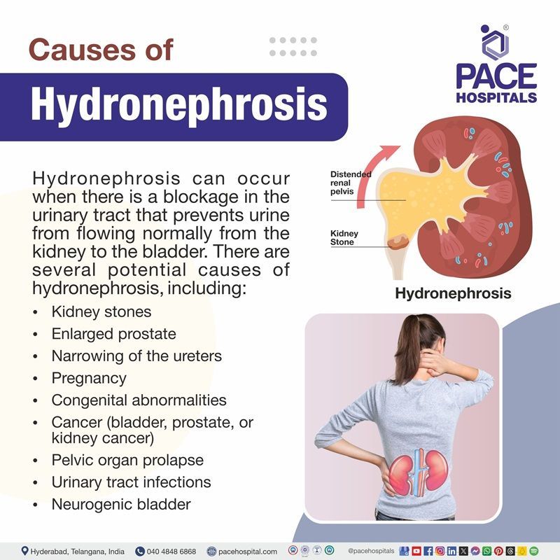 Hydronephrosis causes | hydronephrosis causes in adults | causes of hydronephrosis in infants | causes of hydronephrosis in kidney | causes of mild hydronephrosis