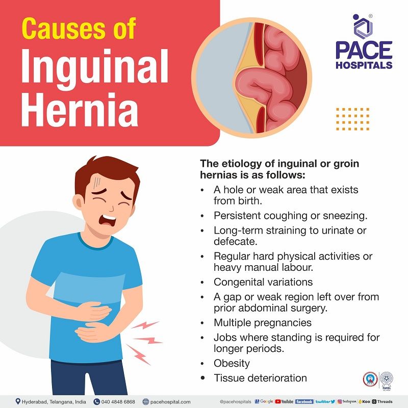 inguinal hernia causes | causes of inguinal hernia in child or infants | direct and indirect inguinal hernia causes and symptoms