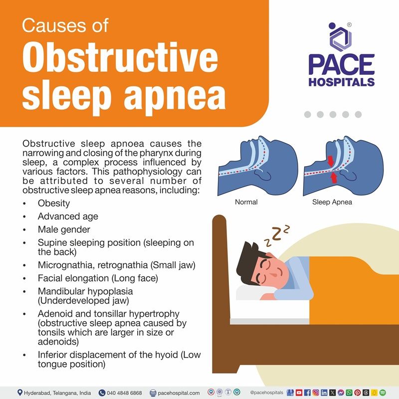 obstructive sleep apnea causes​ | what causes obstructive sleep apnea | causes of obstructive sleep apnea​ | Visual depicting the Causes of obstructive sleep apnea (OSA)