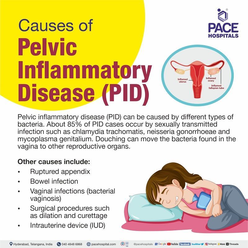PID pelvic inflammatory disease causes | pelvic inflammatory disease caused by endometriosis | acute pelvic inflammatory disease causes
