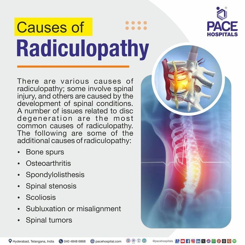 Causes of Radiculopathy Radiculopathy Causes | cervical radiculopathy causes