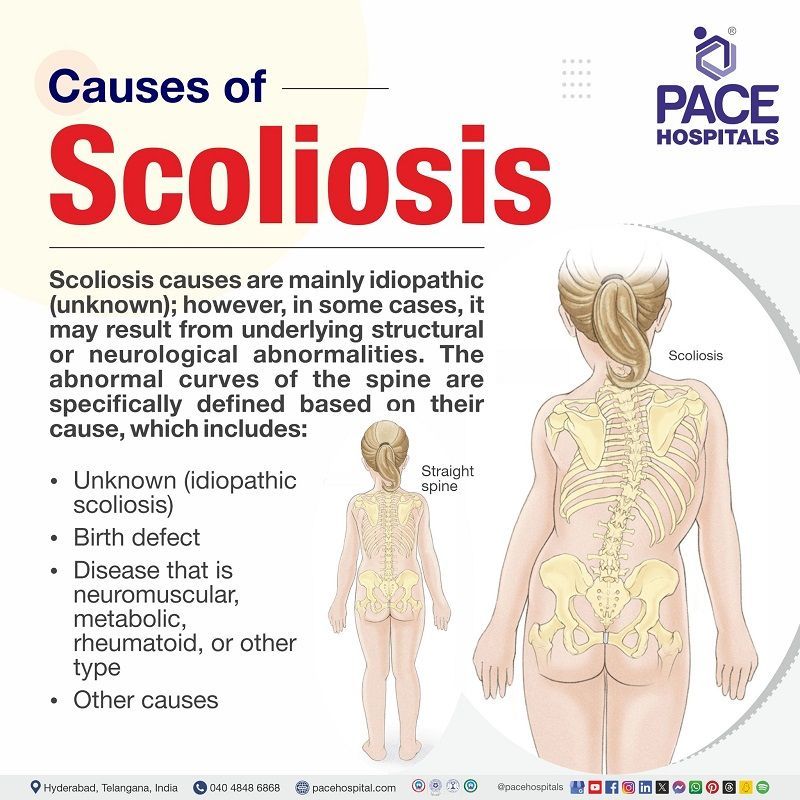 scoliosis causes | what causes scoliosis in adults | causes of scoliosis  | Visual depicting the causes of scoliosis
