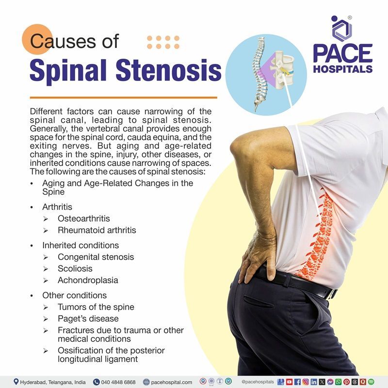 Spinal Stenosis Causes Spinal Stenosis Causes | image showing Causes Spinal Stenosis