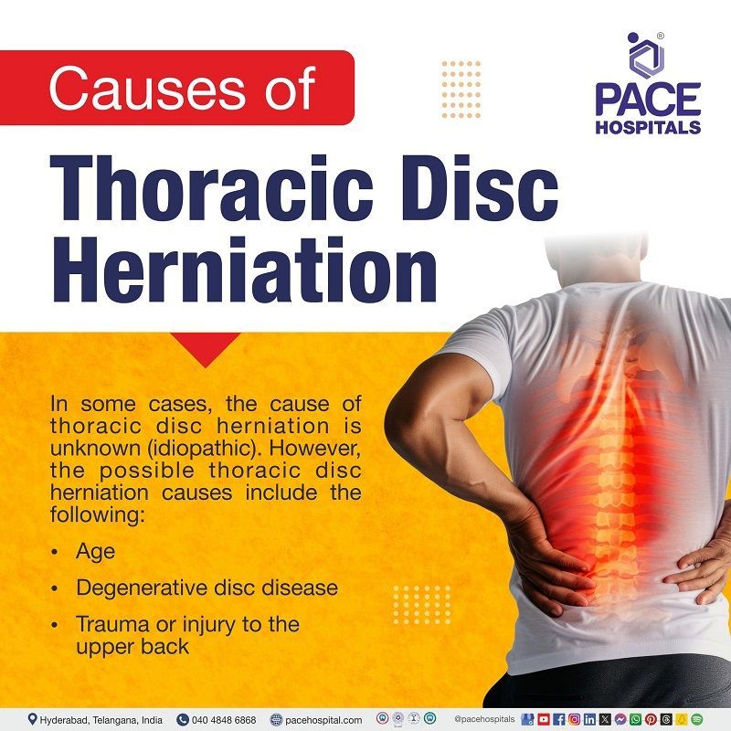 thoracic disc herniation causes | Causes of thoracic disc herniation | What causes thoracic disc herniation | Visual revealing the causes of thoracic disc herniation