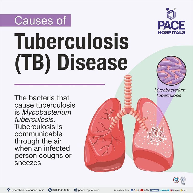 tuberculosis causes | bacteria that causes tuberculosis mycobacterium tuberculosis | causes of pulmonary tuberculosis | how is tuberculosis caused