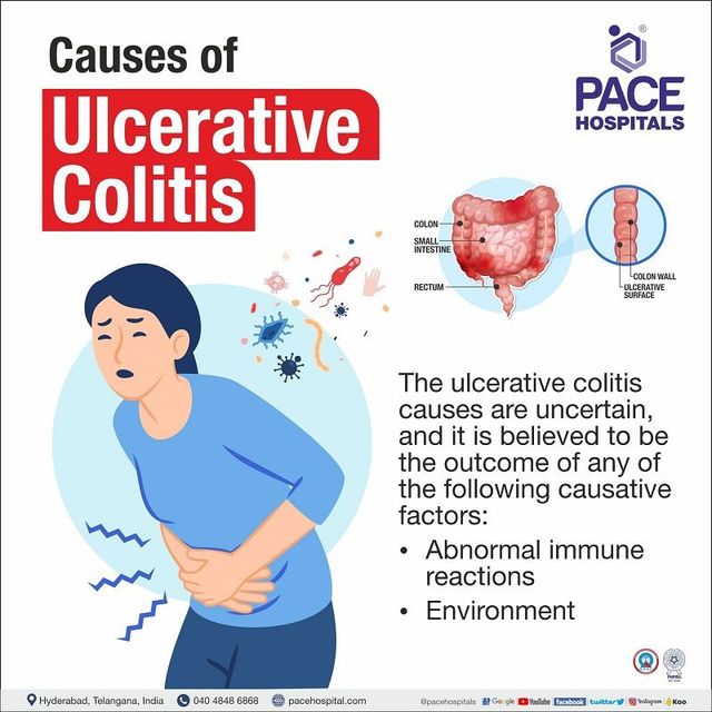 Ulcerative Colitis Pain Location, Frequency, and Other Symptoms