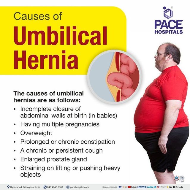 Umbilical hernia - Symptoms, Causes, Complications and Prevention