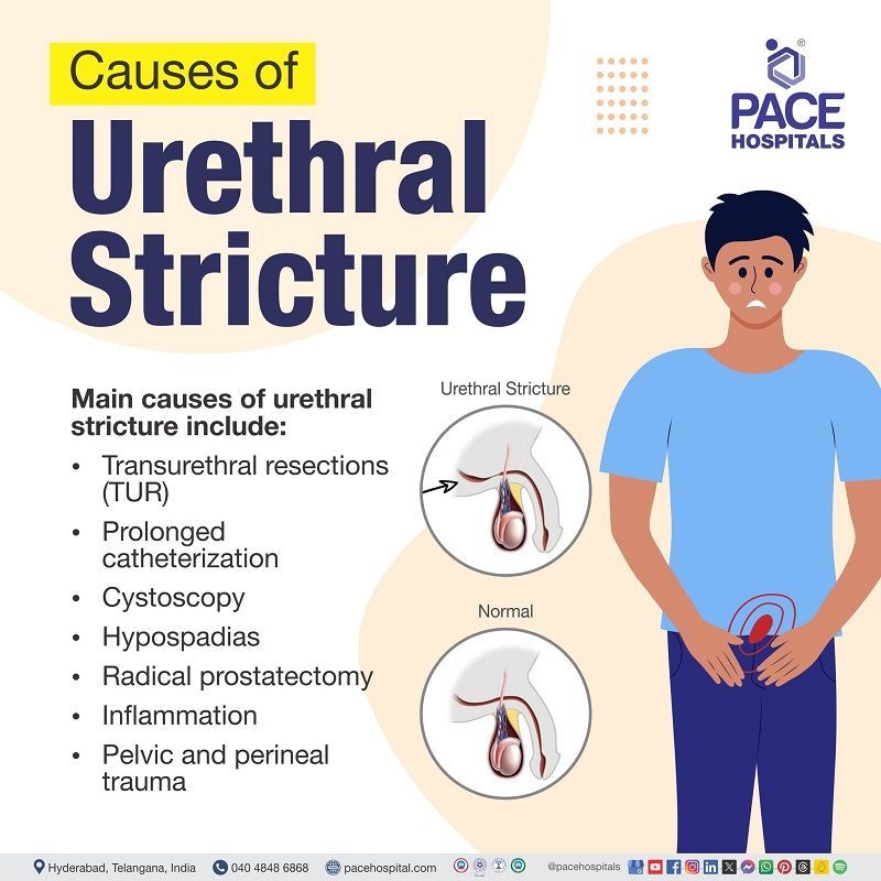 urethral stricture causes | causes
of urethral stricture | what causes urethral stricture | can a catheter cause urethral stricture | Visual revealing the causes of urethral stricture