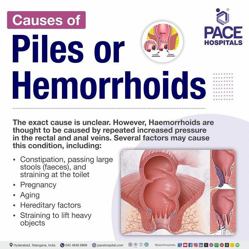 piles causes | hemorrhoids causes | what causes piles | causes of piles in male and Female | causes of external piles | how are piles caused | Visual outlining the causes of Piles (hemorrhoids)
