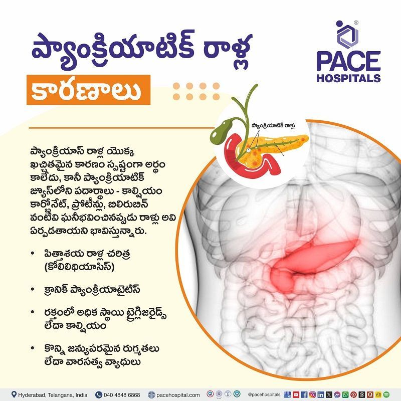 ప్యాంక్రియాటిక్ రాళ్ల కారణాలు | Causes of Pancreatic Stones in Telugu Pancreatic Stones Causes in Telugu | ప్యాంక్రియాటిక్ రాళ్ల కారణాలు | Causes of Pancreatic Stones in Telugu