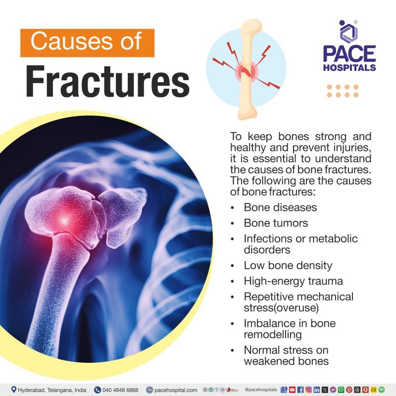 Causes of Fracture Causes of Fracture | Causes of bone fracture | what causes bone fractures
