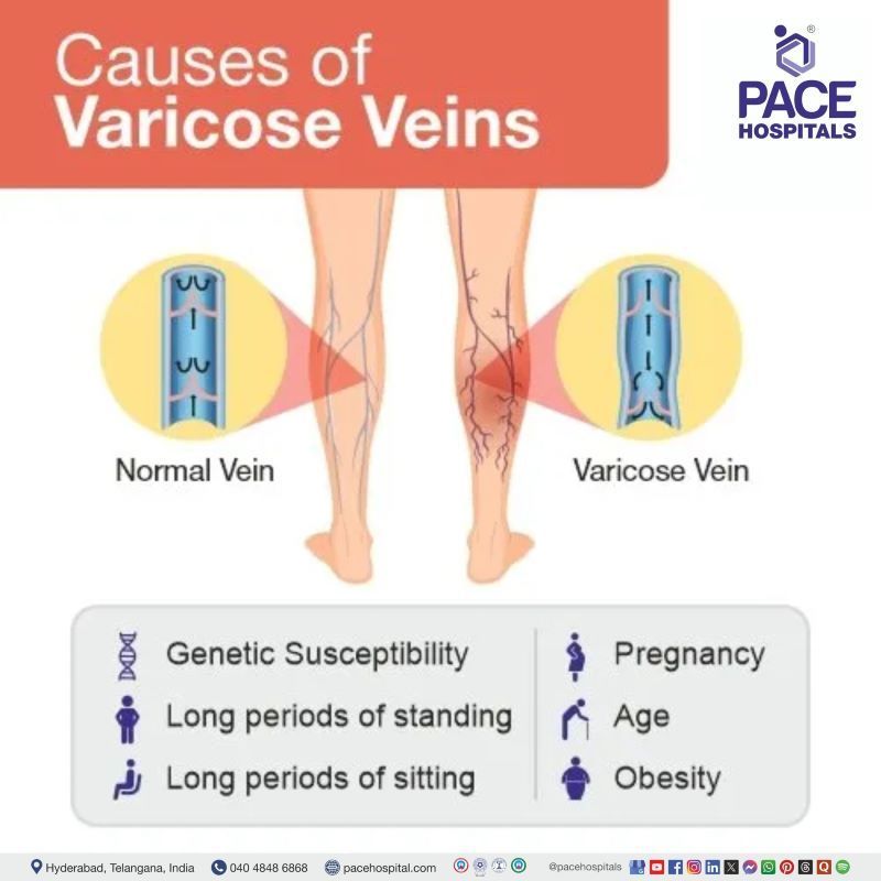 Varicose Veins Causes what causes varicose veins | Varicose Veins Causes