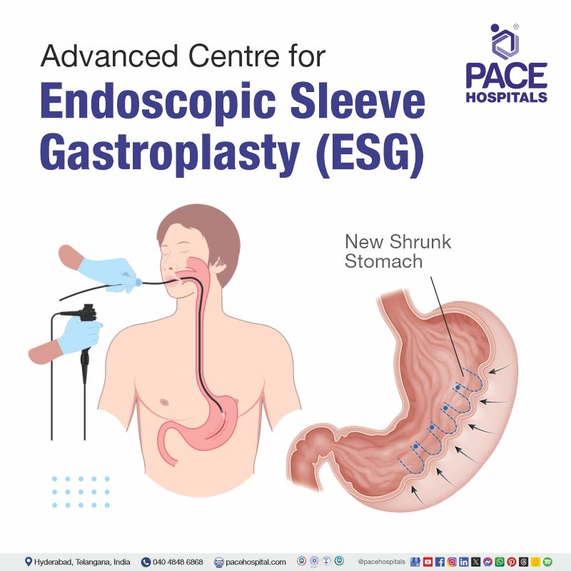 endoscopic sleeve gastroplasty near me | endoscopic sleeve gastroplasty cost in Hyderabad India | Best hospital for Endoscopic Sleeve Gastroplasty in Hyderabad India