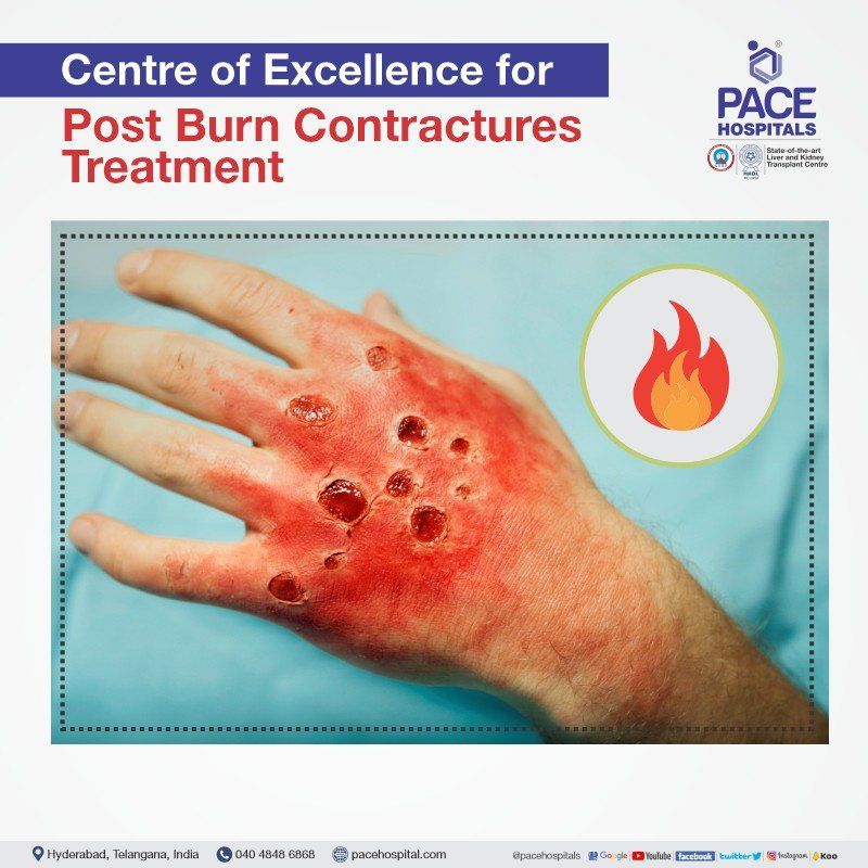 Post burn contracture surgery in Hyderabad | burns and post burn contractures
