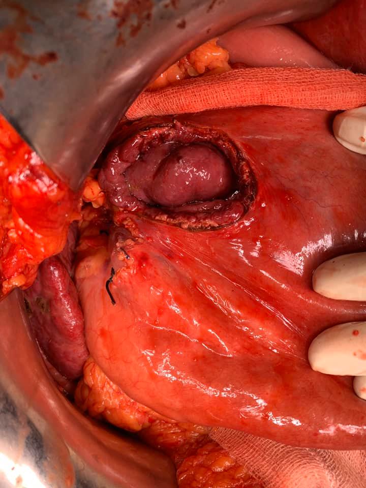 Child’s A CLD with HUGE gastric varices uncontrolled