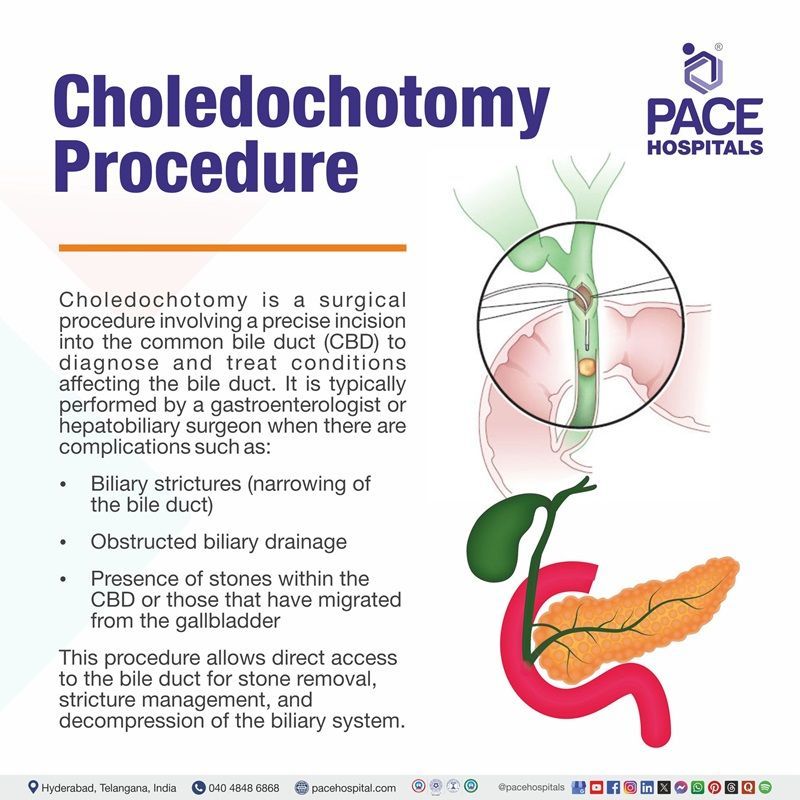 What is Choledochotomy Procedure​ | Choledochotomy Meaning | Choledochotomy Definition