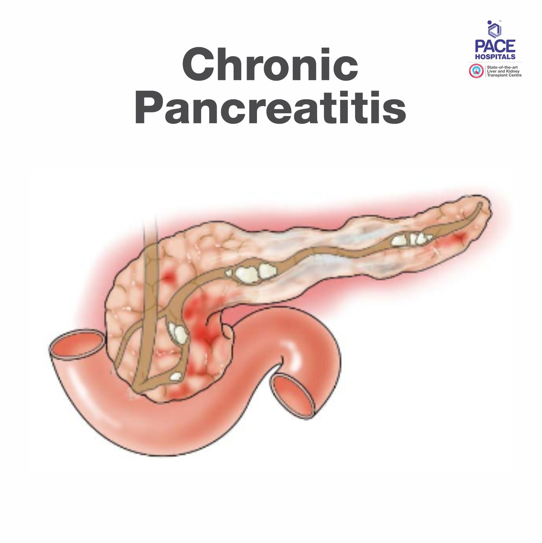 Chronic Pancreatitis Treatment in Hyderabad