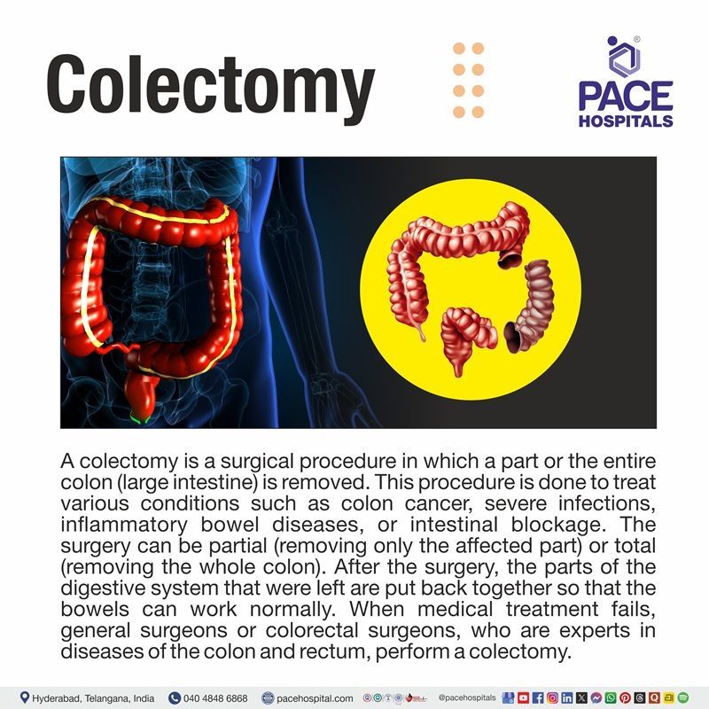 Colectomy Meaning Whst is Colectomy | Colectomy Procedure | Partial & Total Colectomy | Colon resection Surgery