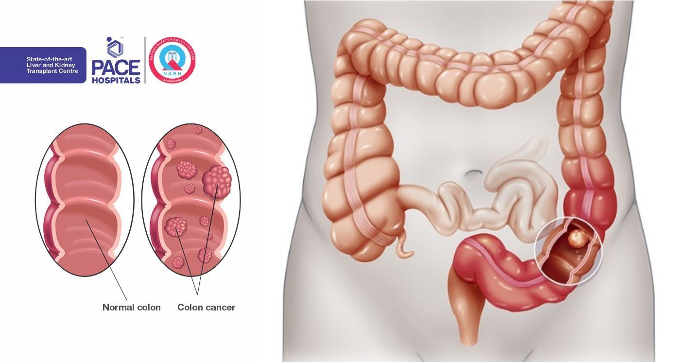 Piles or Colon Cancer? Does Piles cause Colon Cancer - Dr Maran -  Springfield Wellness Centre