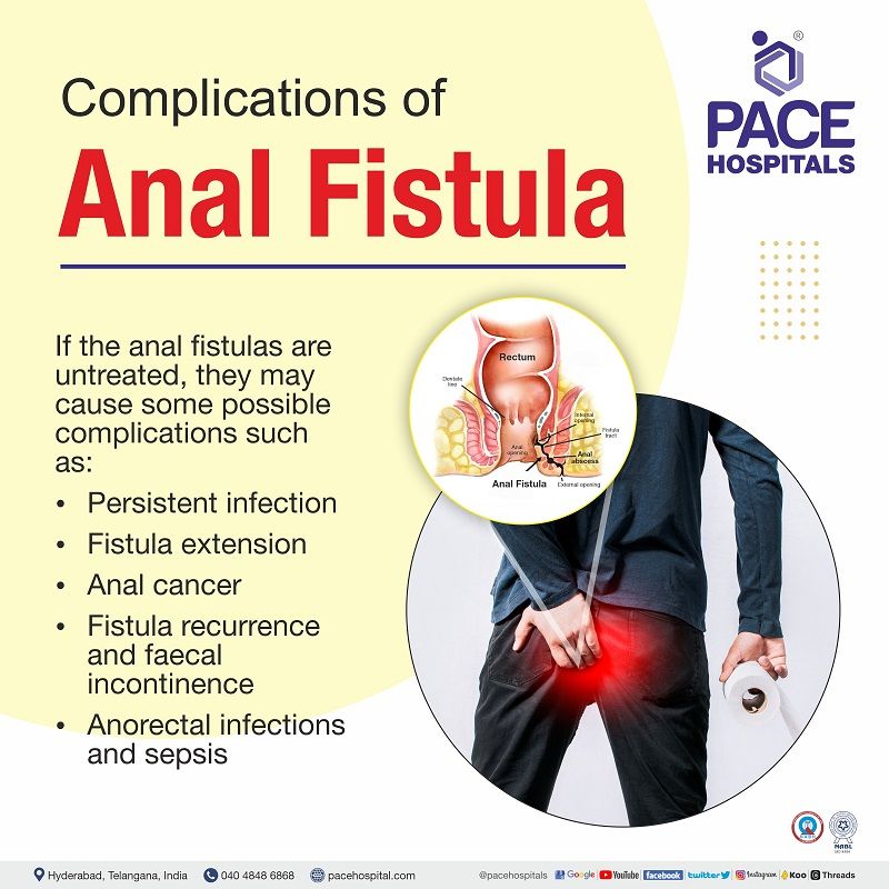 anal fistula complications | fistula in ano complications | complicated fistula in ano